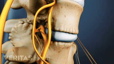 Medical illustration of two vertebrae showing bone spurs on the facet joints