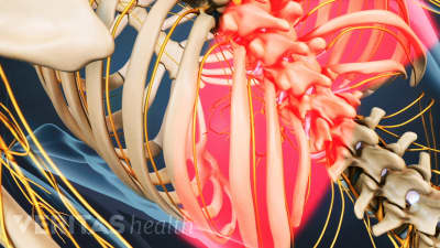 Videoteca de osteoporosis