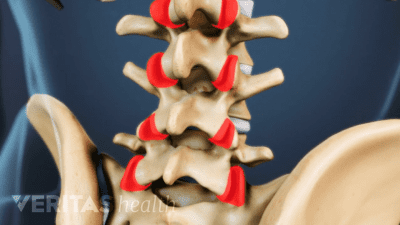 Posterior view of the lower back highlighting facet joints in the lumbar spine.