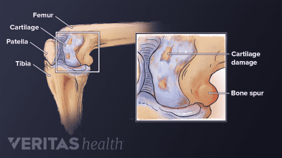 Tibia (shin bone), femur (thigh bone), and patella (kneecap). cartilage damage, and bone spurs labeled in the knee joint.