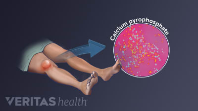 Pseudogout in the knee from the buildup of calcium pyrophosphate crystals.