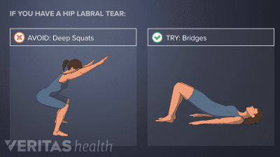 Exercises to do and avoid with a hip labral tear.