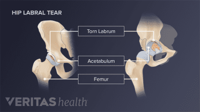 A painful torn labrum in the hip.