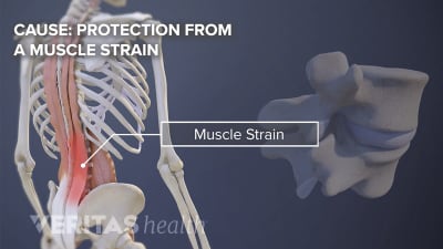 Muscle strain in the lower back