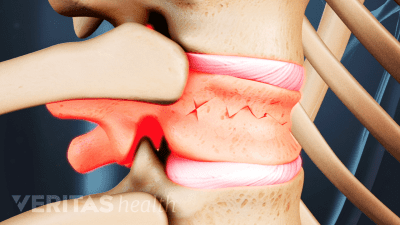 Spinal compression fracture in the thoracic spine.
