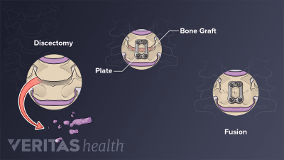 Anterior Cervical Discectomy and Fusion (ACDF) Video | Spine-health