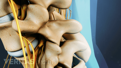Lumbar Microdiscectomy Surgery Video | Spine-health
