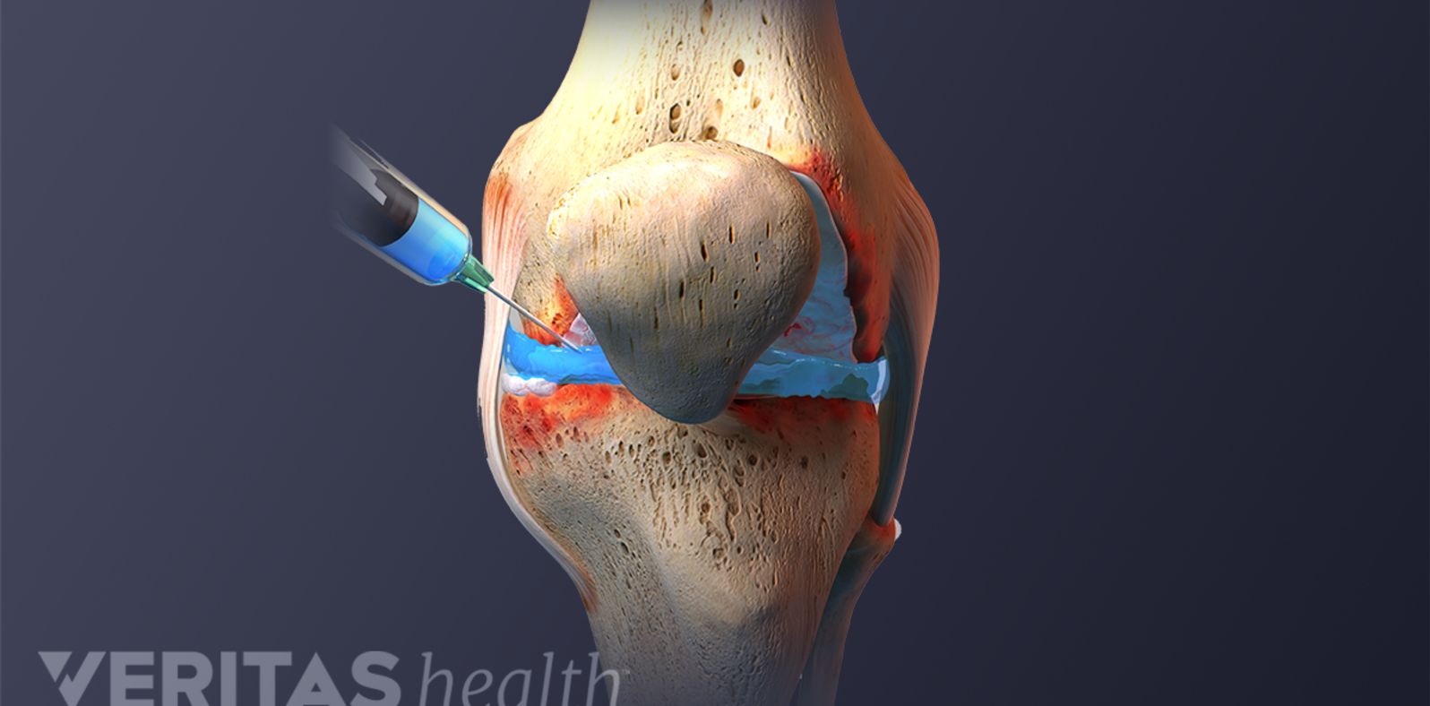 Left Knee Injection Trusted Information for Sports Injury Relief | Sports-health