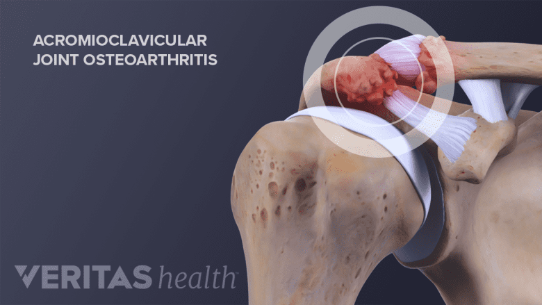 Medical illustration of acromioclavicular (AC) joint arthritis