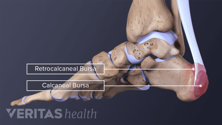 Medial view of bursa on the ankle.
