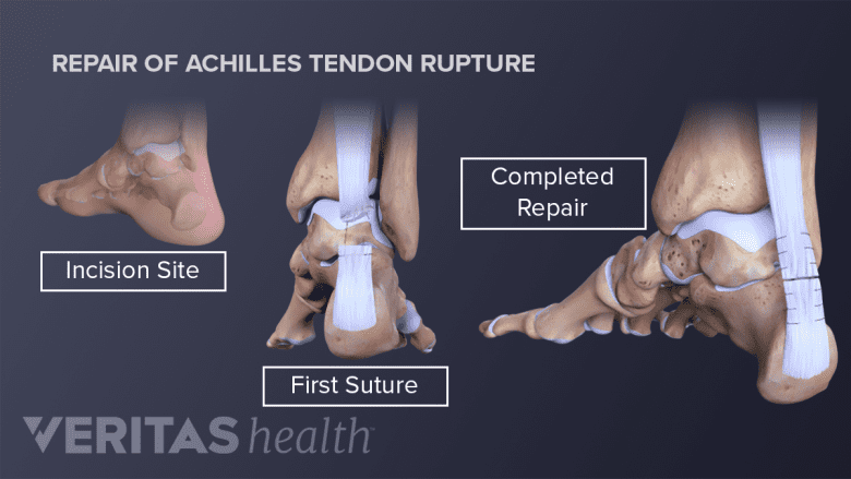 Achilles Tendon Rupture Surgery Achilles Tendon Rupture Surgery