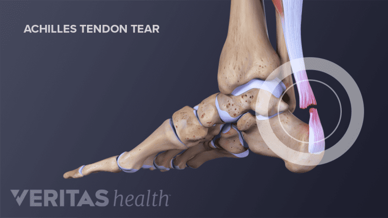 Medial view of the foot showing a rupture of the achilles tendon.