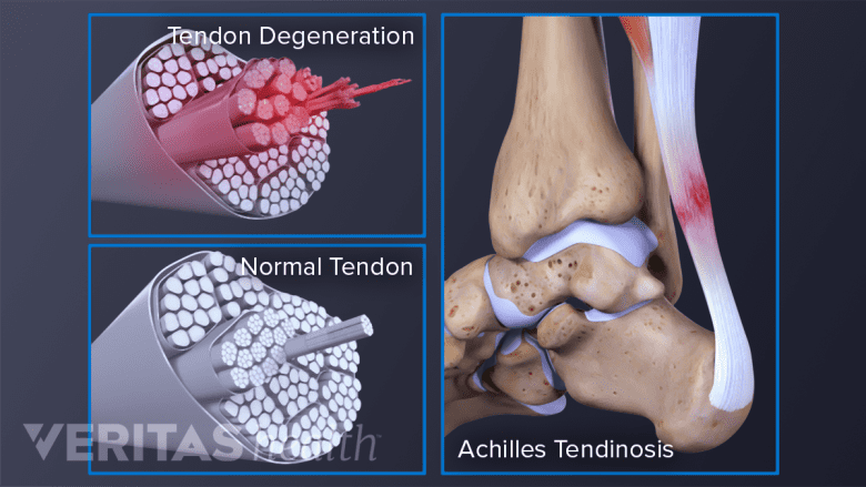 Illustration showing Tendon degeneration, normal tendon and achilles tendinosis.