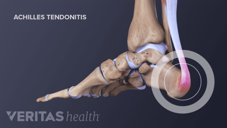 Side view of the foot showing pain in the heel for achilles tendonitis.