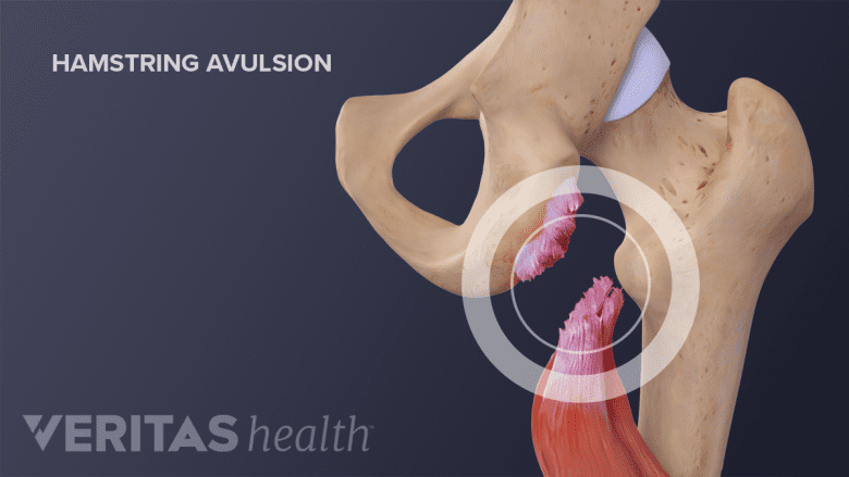 Illustration showing hamstring muscle with aulsion injury.