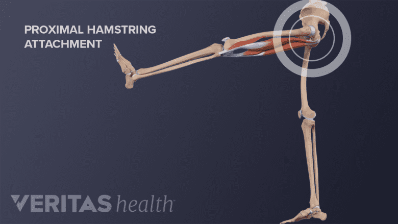 Illustration showing anatomy of hamstring muscle with proximal hamstring attachment.