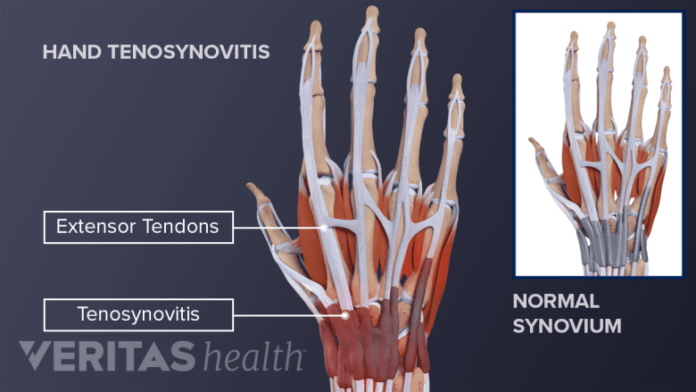 Hand tenosynovitis highlighting the extensor tendons and comparing it to the normal synovium