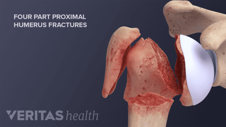 Four part proximal humerus fractures