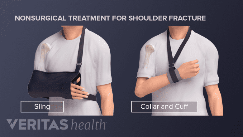 Person with a humerus fracture using a sling or collar and second inset showing using a cuff.