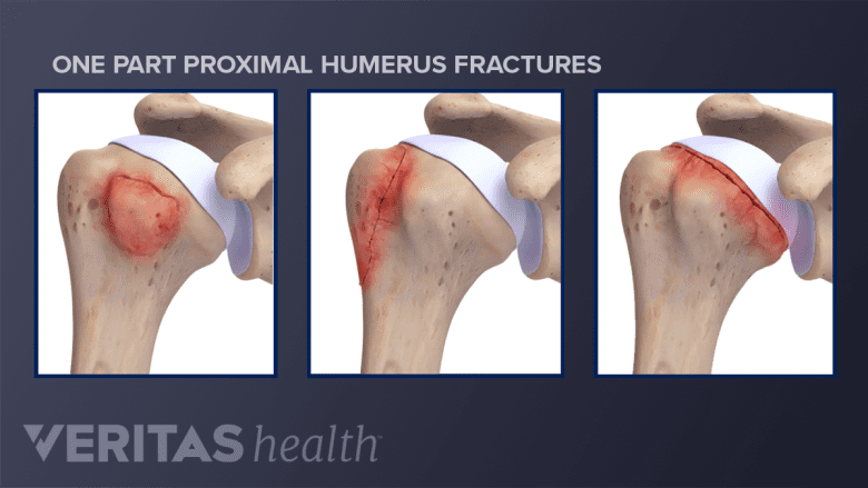 One part proximal humerus fractures