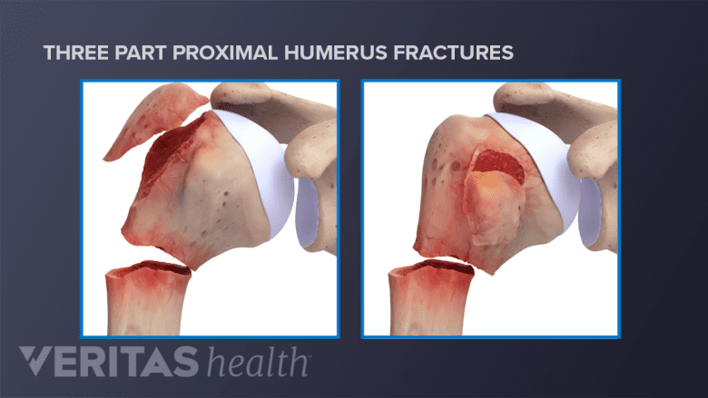Three part proximal humerus fractures