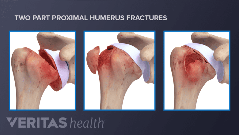 Two part proximal humerus fractures