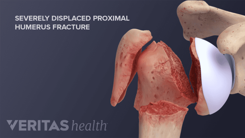 Diagram of a severely displaced proximal humerus fracture
