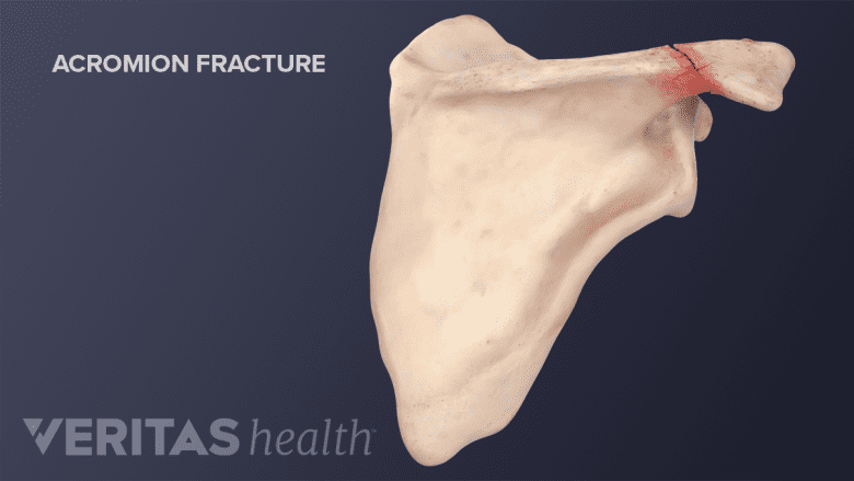 Acromion Fracture