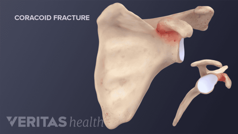 Coracoid Fracture