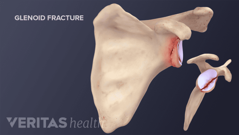 Glenoid Fracture