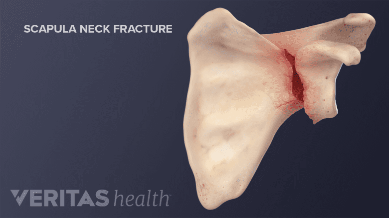 Scapula Neck Fracture