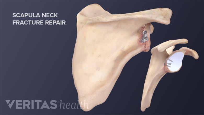 Surgical treatment of scapula or shoulder blade fracture.