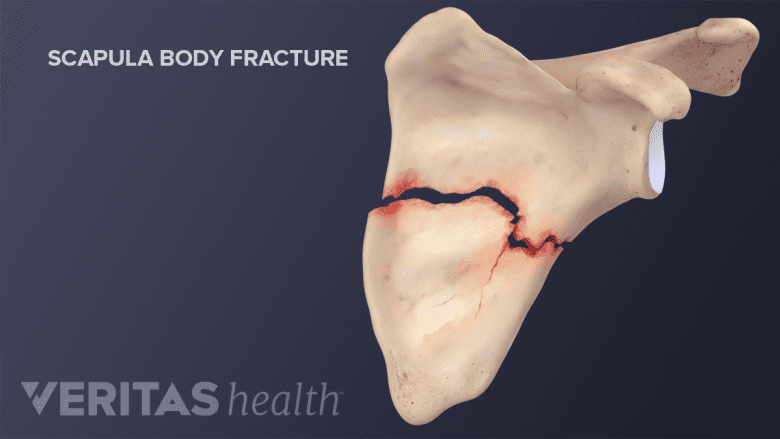 Scapula body fracture