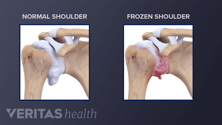 Illustration showing normal shoulder joint and frozen shoulder joint anatomy.