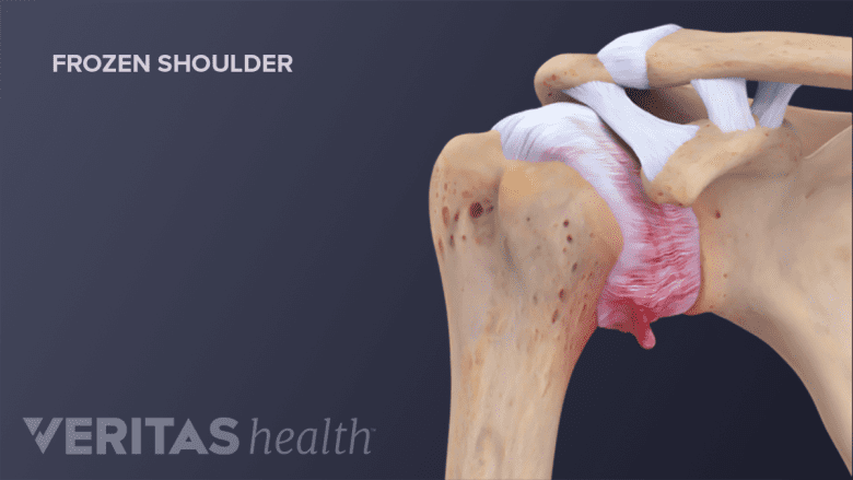 Cross section of normal joint compared to one with frozen shoulder (adhesive capsulitis).