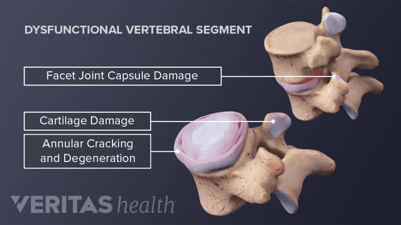 Thoracic Herniated Disc Causes