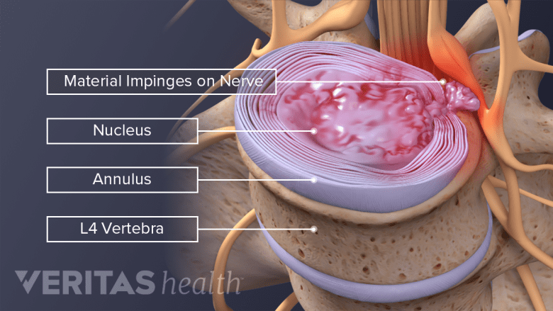 Top down illustration of a herniated disc in the L4 lumbar vertebra.