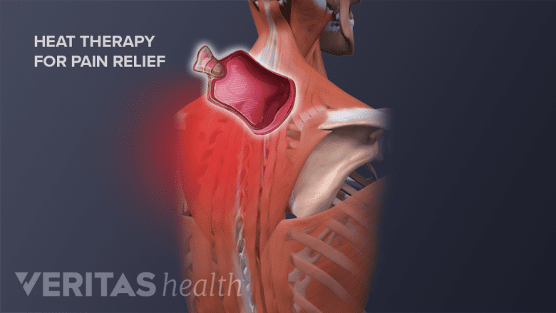 Posterior view of upper back with red highlight and a icon of heat pack.