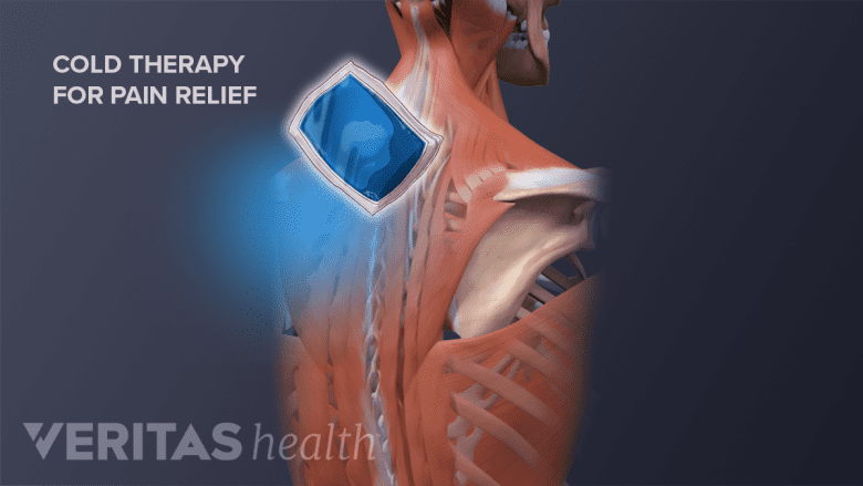 Illustration showing posterior view of neck and upper back with an ice pack icon.