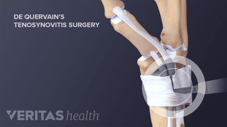 Incision from De Quervain’s Tenosynovitis Surgery.