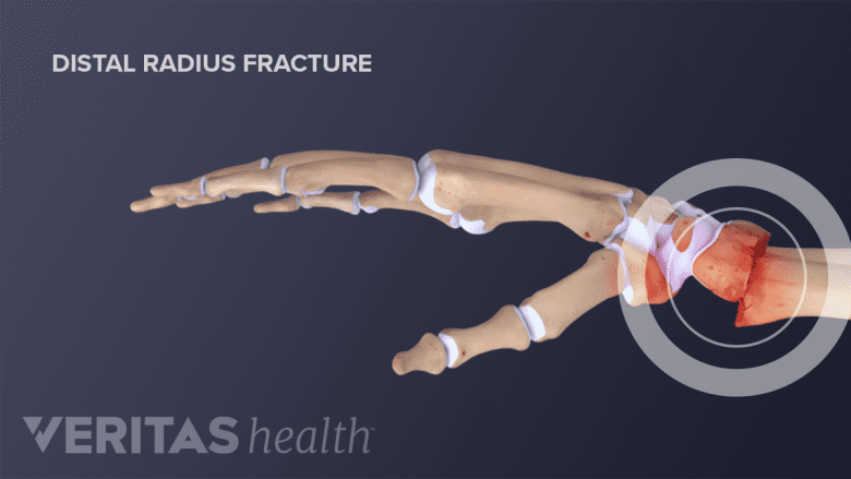 A distal radius fracuture occurs when the there is a break in the wrist end of the radius bone.