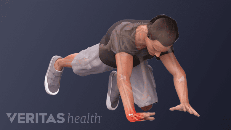 Illustartion showing a man with wrist injury.