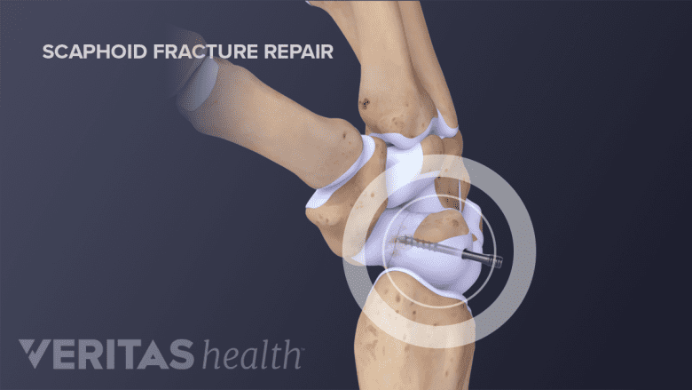 Scaphoid fracture repair