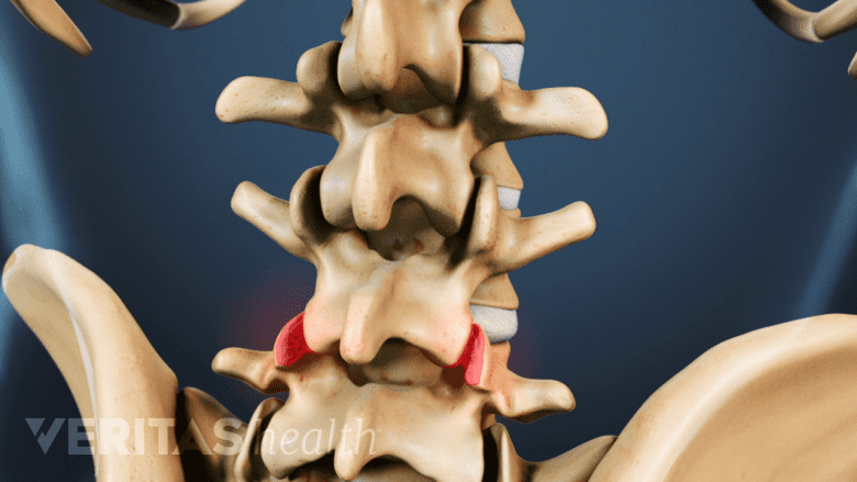 Illustration showing lumbar spine with facet joint highlighted in red.