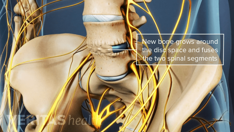 Illustration showing pelvis with bone growth around the disc space.