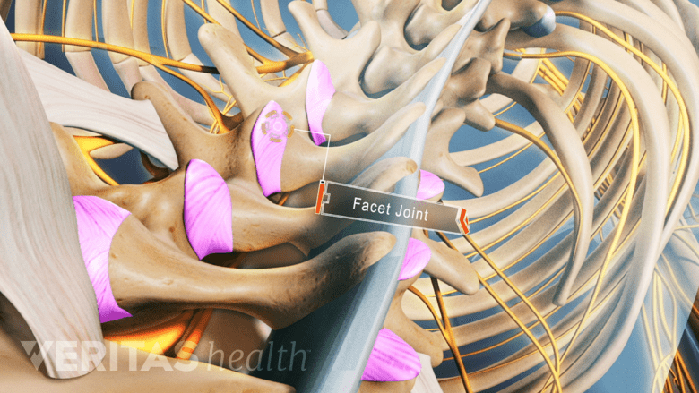 Illustration of the facet joints in the lumbar spine affected by ankylosing spondylitis