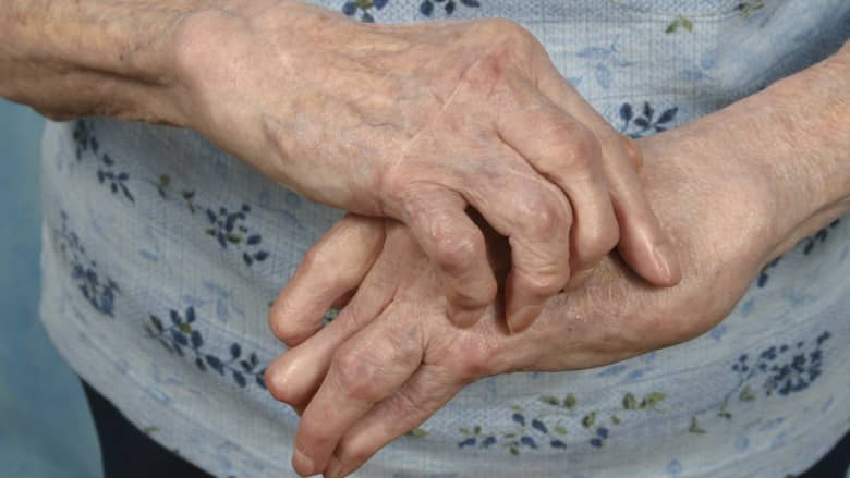 Arthritic hands massaging one another.