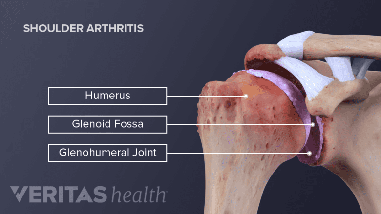 Illustration showing shoulder joint anatomy with shoulder arthritis.