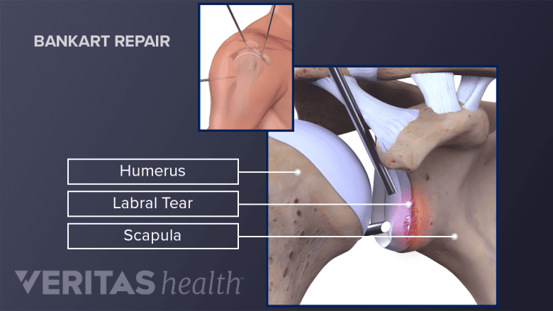 Arthroscopic bankart repair for shoulder dislocation