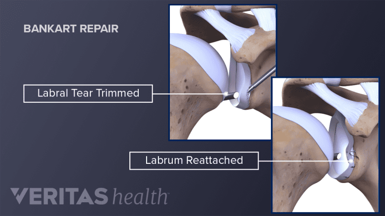 Anterior view of a Bankart repair for dislocated shoulder